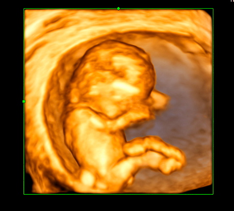 8 week ultrasound 3d twins