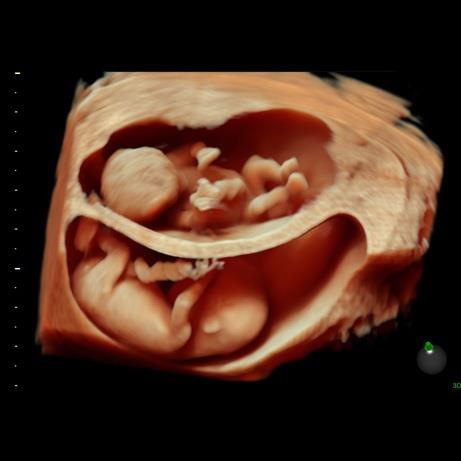 12 week 3d ultrasound gender