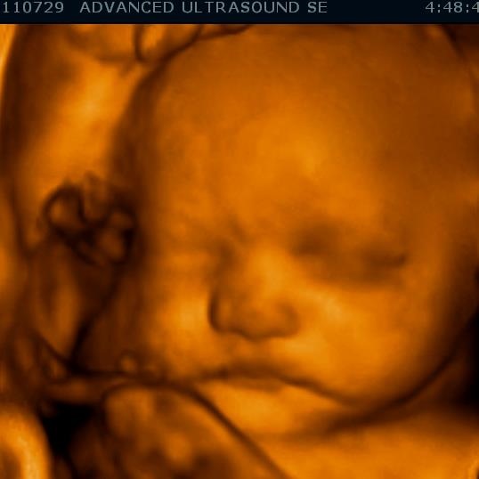 down syndrome 18 week ultrasound 4d