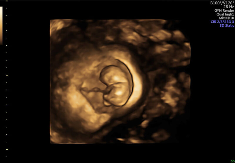 4d ultrasound pictures
